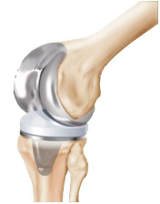 Эндопротезирование коленного сустава - Операция по замене коленного сустава в г. Черновцы