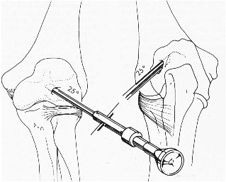 Артроскопия локтевого сустава выполняется под проводниковой или общей анестезией