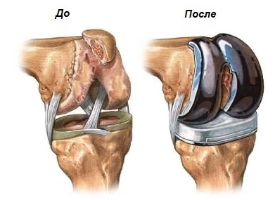 До и после операции по замене коленного сустава