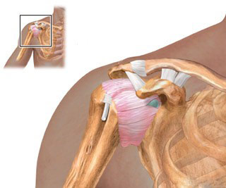 Травмы плечевого сустава - Разрыв мышц