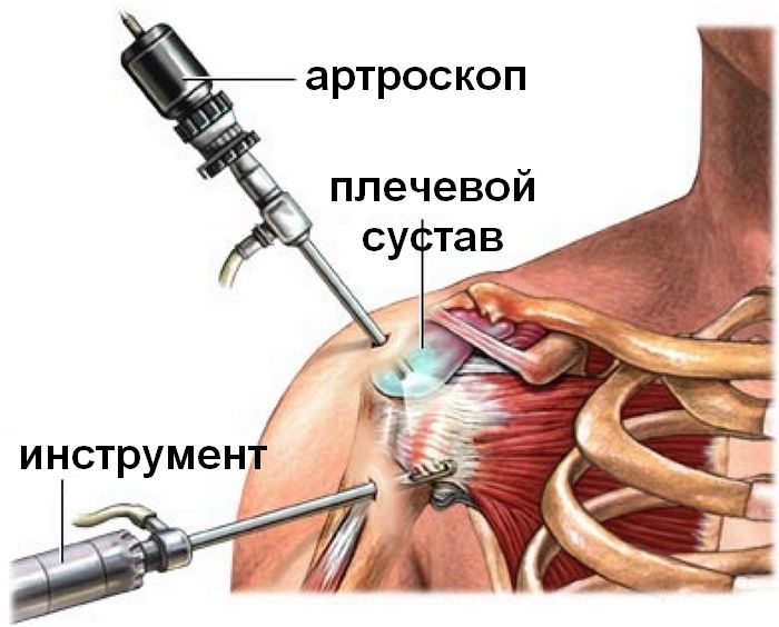 Артроскопия плечевого суставов